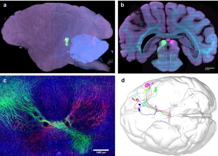 脑科学日报:“老年痴呆”要改名了?青年型痴呆的发病率超乎想象