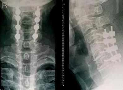 成功开展“钥匙孔”技术治疗颈椎病