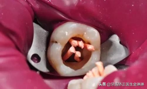 大牙没了怎么办,大牙没了用什么方法弥补