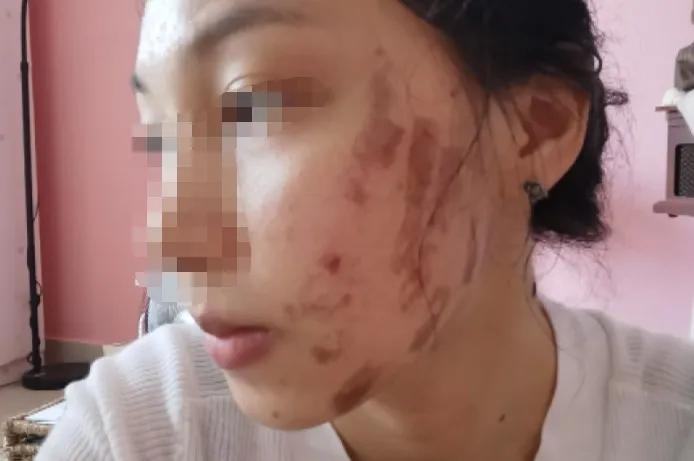 广西女子毁容后续,一妇女惨遭毁容