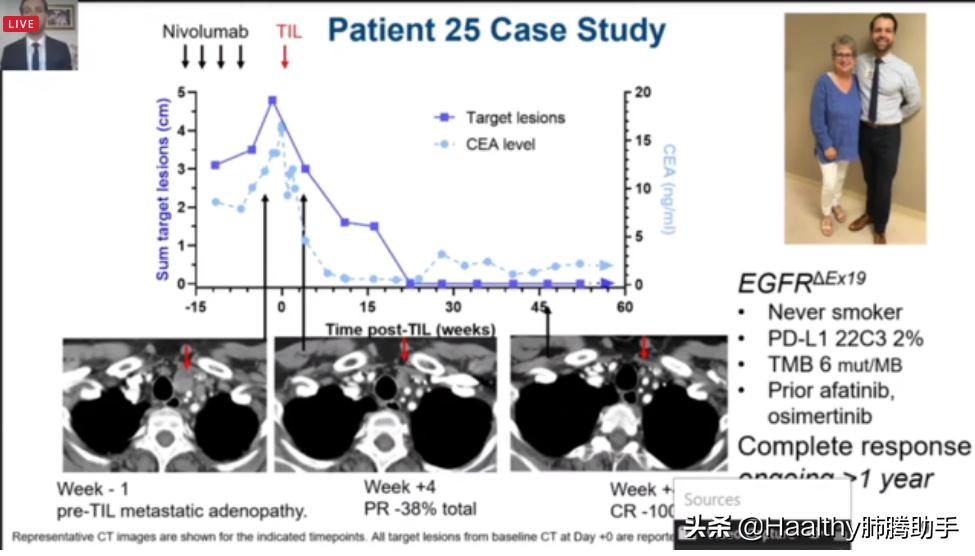 免疫治疗耐药后该怎么治疗,免疫治疗耐药的症状
