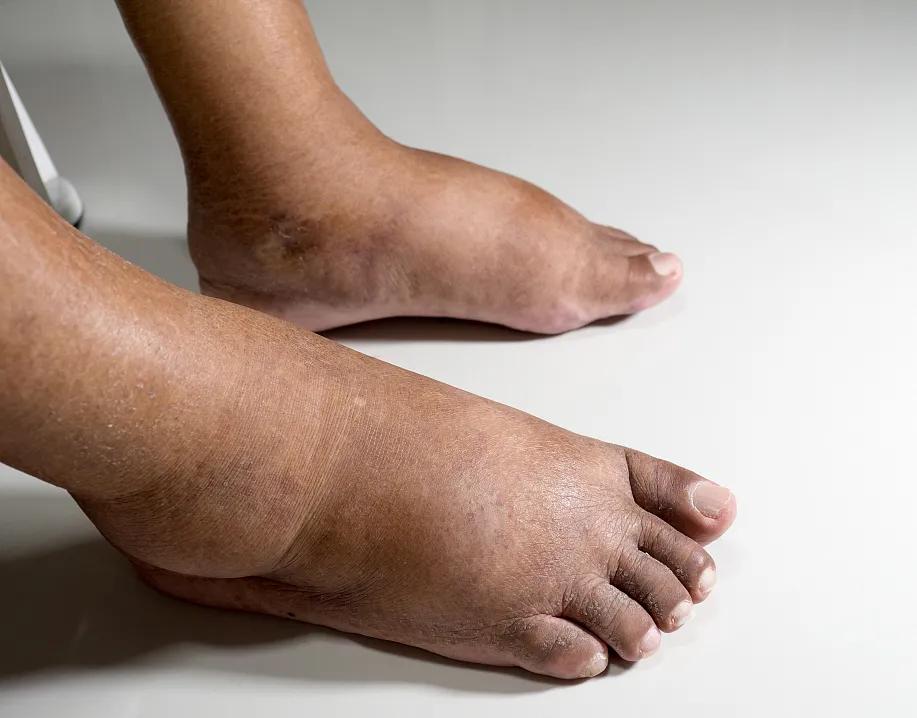 糖尿病仅仅是尿里糖分高吗？这几种并发症可致死、致残