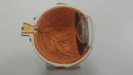 50岁男子用头顶了个球,晶状体脱位,悲剧了