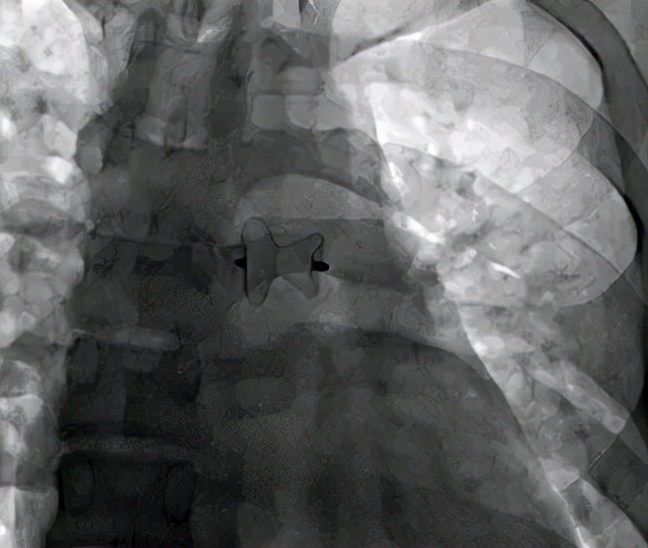 先天性心脏病做导管过程,让常见先天性心脏病进入微创时代
