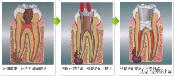 牙齿缺了一小块疼痛怎么办,牙齿缺了一块很疼怎么补救