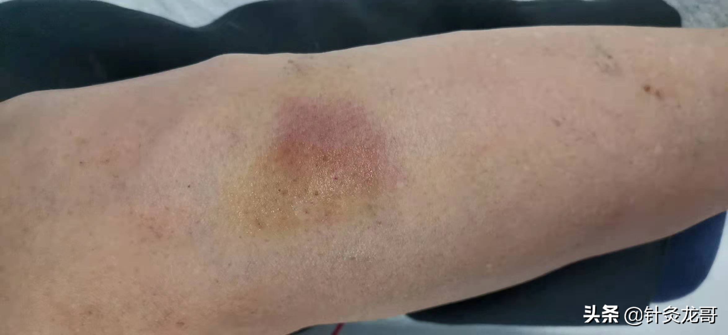 针灸出现淤青怎么处理,针灸出现淤青是不是血瘀了