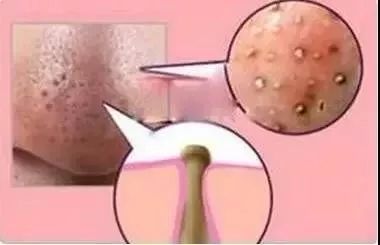 棰濆ご绮夊埡闂彛鎬庝箞鍘婚櫎,鍘婚櫎闂彛绮夊埡鐨勬姢鑲ゅ搧