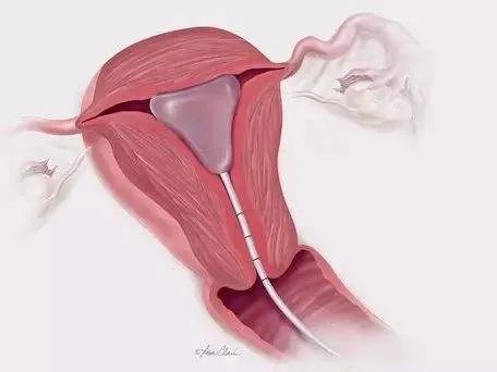 输卵管造影十大忌讳,输卵管造影真实案例感受