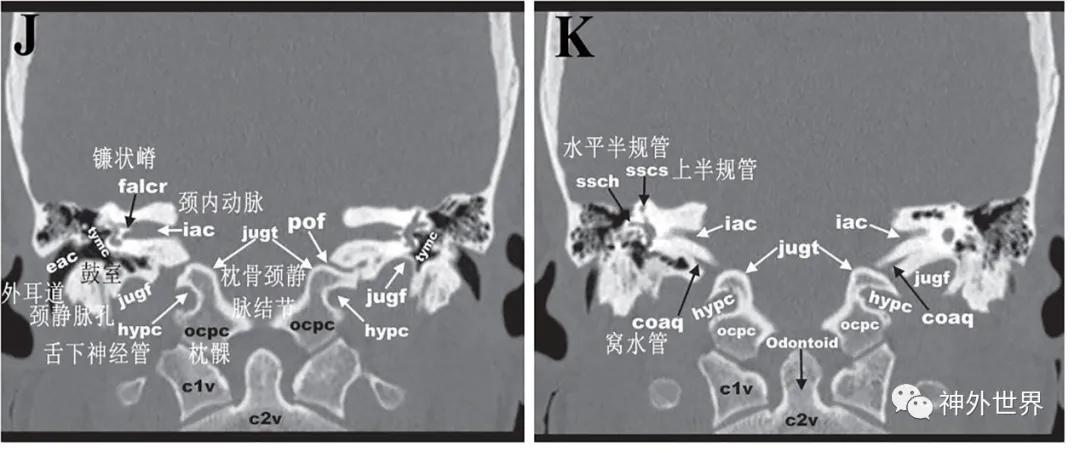 颅底骨折合并脑脊液漏伤情鉴定,颅底骨折伴脑脊液漏右眼眶骨折