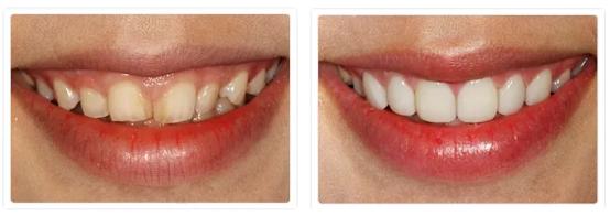 什么方法最适合去黄牙不伤牙齿,一口老黄牙怎么治疗