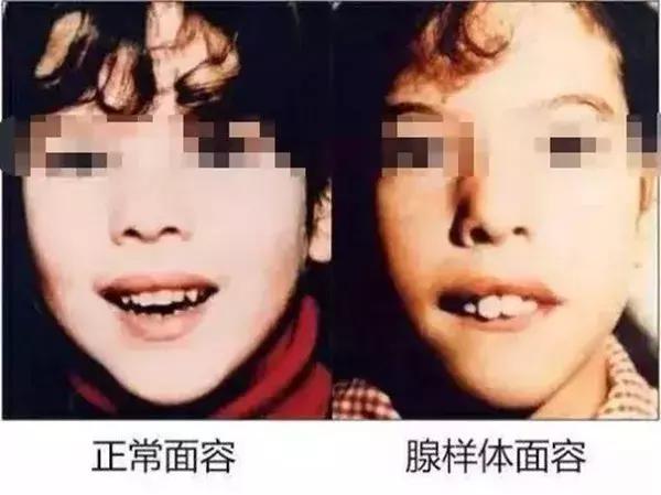 长期口呼吸的人是不是很没出息,长期口呼吸让人变丑