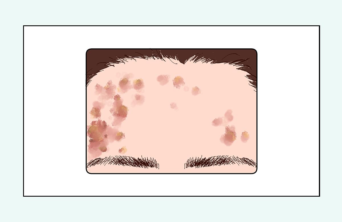 脸上的红疙瘩疼是什么原因,脸上的各种疙瘩