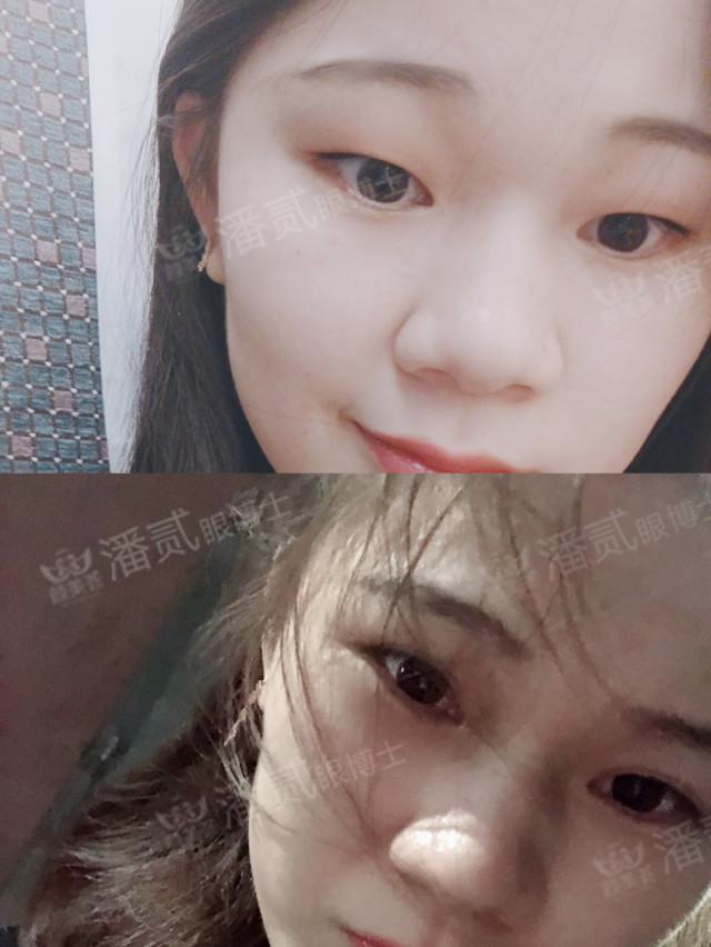 什么样的肿眼泡适合全切,什么样的肿眼泡不用动提肌