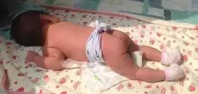 宝宝晒黄疸晒太阳晒伤了怎么办,宝宝晒太阳退黄疸视频