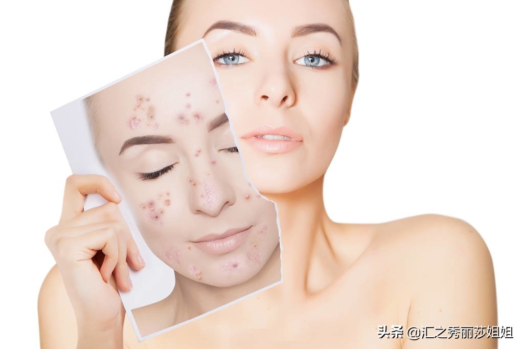 手挤黑头和挤眼眶上的黑头粉刺,去除黑头效果好且无刺激的方法