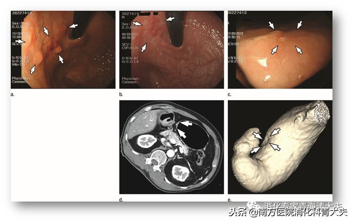 早期胃癌内镜手术后评估,早期胃癌内镜下EMR和ESD适应症
