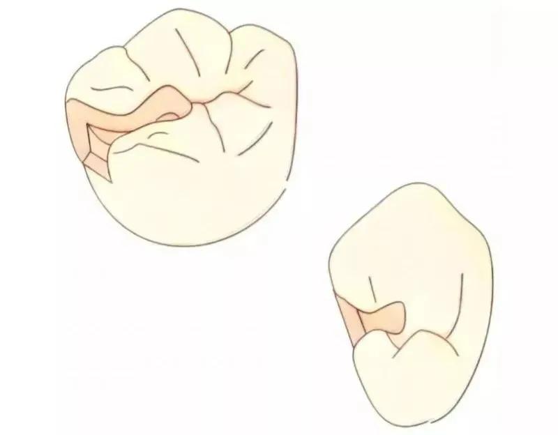 补一颗牙把好牙打磨了,上牙把下牙磨了一个坑