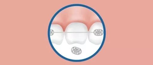 牙套的最后一个托槽掉落要紧吗,为什么牙套托槽那么容易掉