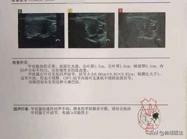 甲亢合并甲癌为什么要全切,甲亢合并甲状腺肿大怎么治疗