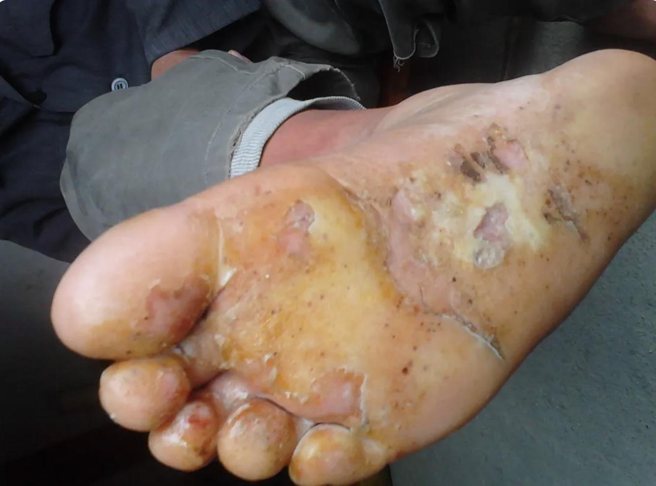 足癣中医病因,足癣治好案例