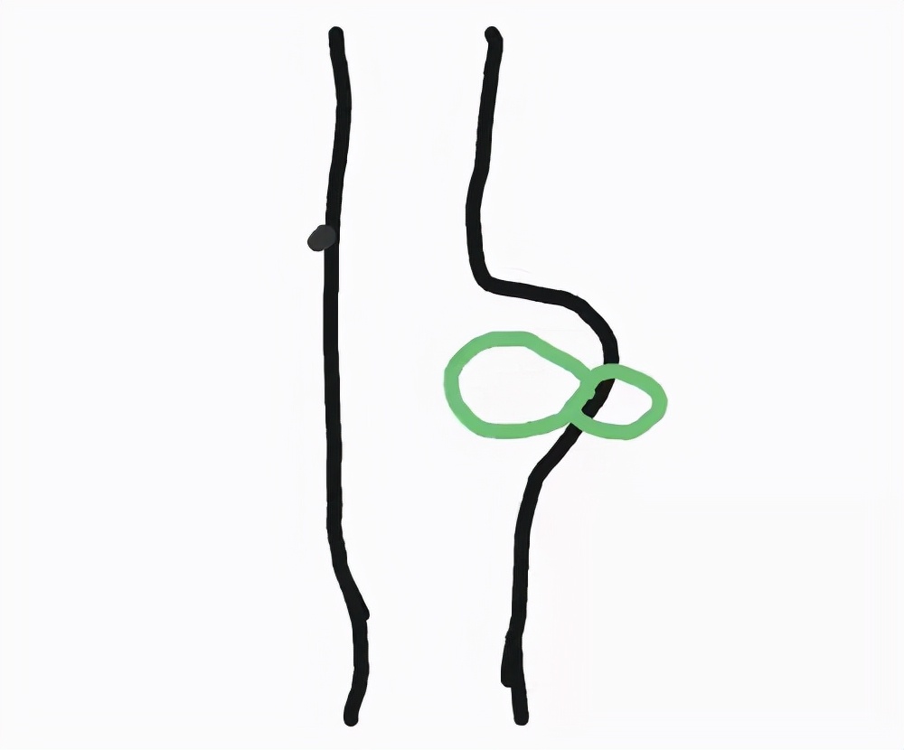 臀部里长了个硬硬的瘤子,臀部上长个瘤子不疼不痒软软的