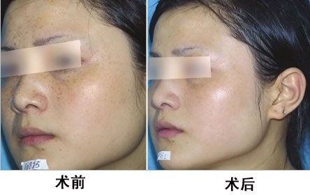 脸上有斑用什么护肤品祛斑效果好,40岁女人脸上长斑怎样有效祛斑