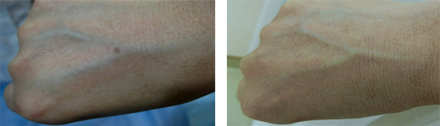 激光美容有哪些项目,激光美容都有哪些项目