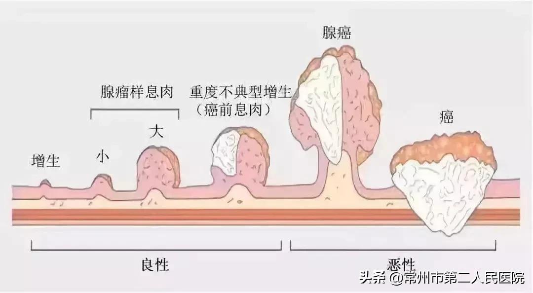 人到中年有必要做肠胃镜检查吗,哪些人需要定期做胃肠道体检