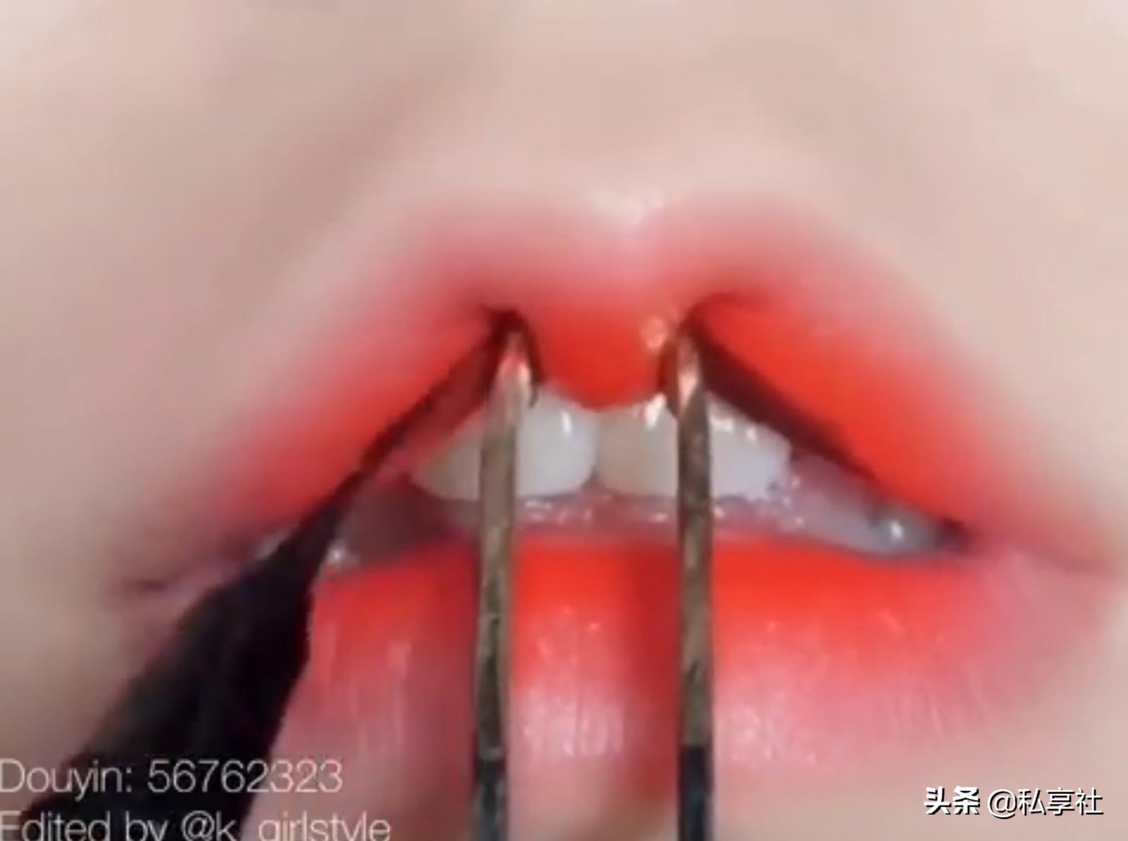 医美唇形改善多少钱,改善唇形医美