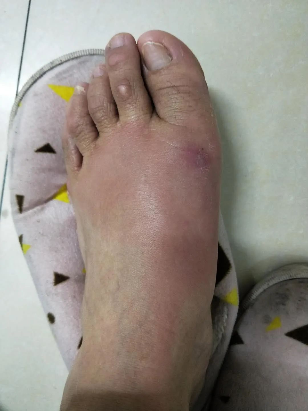 及时治疗脚气，是对家人最好的负责