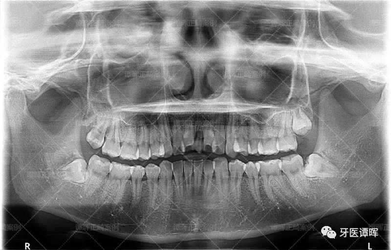 门牙前突牙齿不齐矫正案例分享,门牙和旁边牙齿不齐最快矫正方法