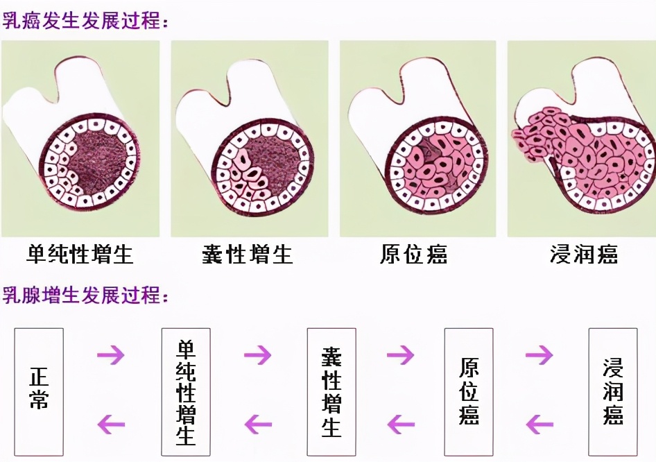 乳房增生有几级,80%的女性有乳腺增生