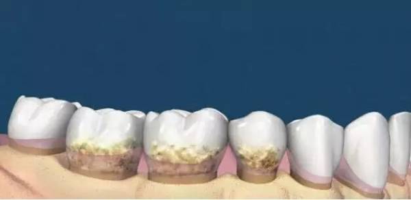 洗牙到底怎么洗好,洗牙洗的不干净