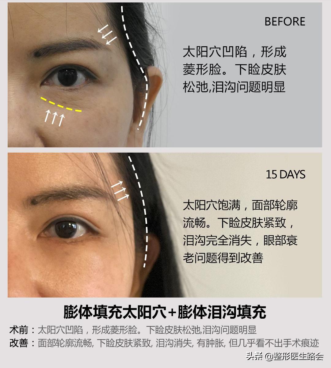 太阳穴凹陷颧骨高适合留中分吗,太阳穴凹颧骨高用什么哑光高光好