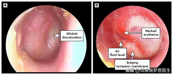 三个月宝宝耳朵流脓了怎么办,3个月宝宝耳朵流脓怎么办