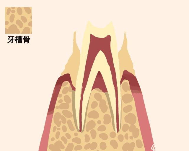 牙齿缺失10年倾斜脱落图,一张动图告诉你