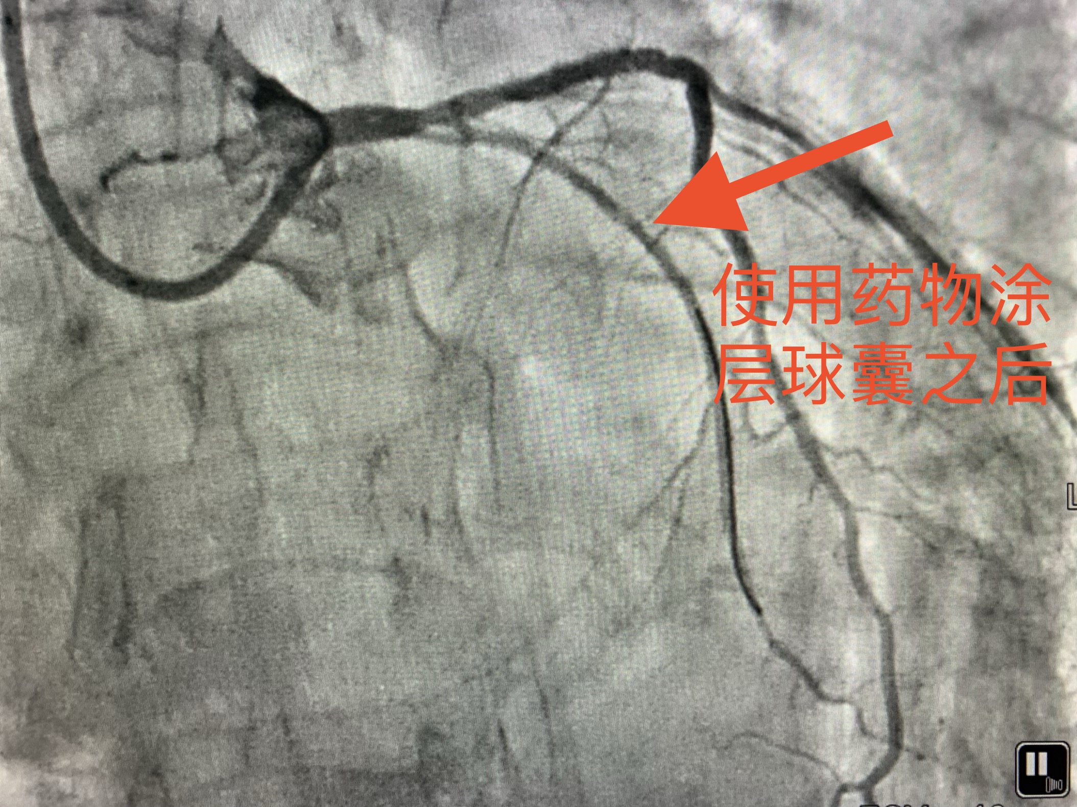 冠心病能否不用支架用中药调理,冠心病做支架好还是保守治疗好