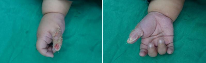 10个月宝宝长6厘米正常吗,婴儿有6个手指是小手术吗