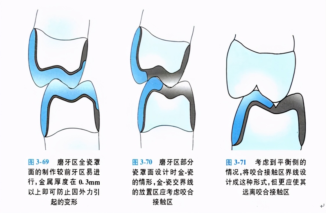 口腔金属冠与全瓷冠的区别,牙科医生讲义
