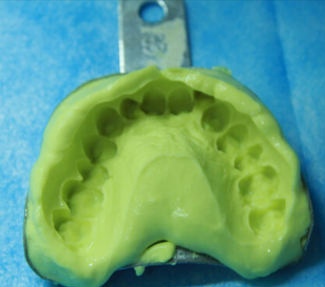 第一次根管治疗牙齿一碰就疼,牙齿做根管治疗要多少钱