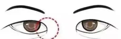 割双眼皮内外眼角都开,做双眼皮开外眼角会回缩吗