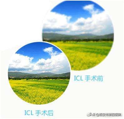 icl术后注意事项,icl术后用眼注意事项