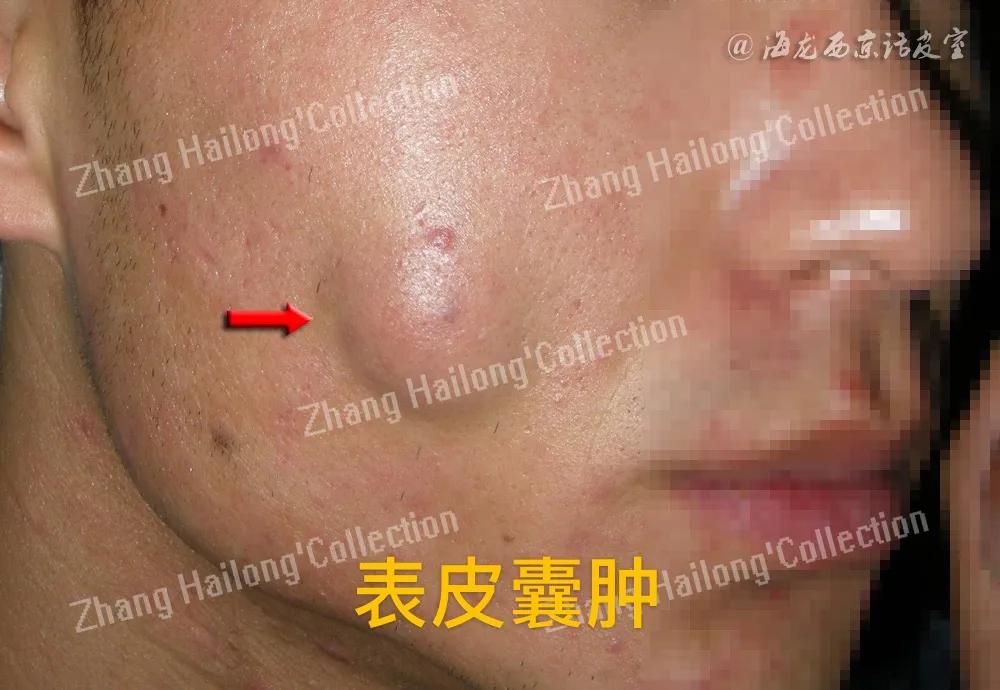 表皮囊肿会引起癌变吗,表皮囊肿是先天性的吗