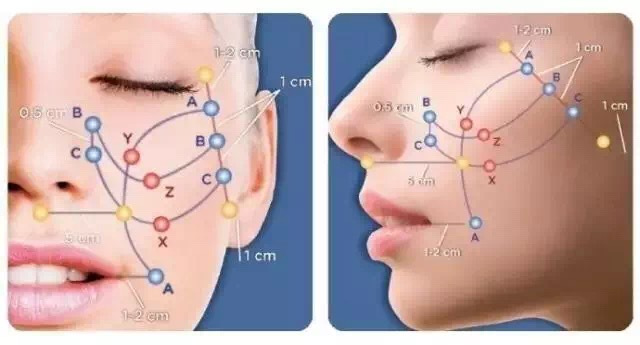 埋线提升,埋线提升需要几根线