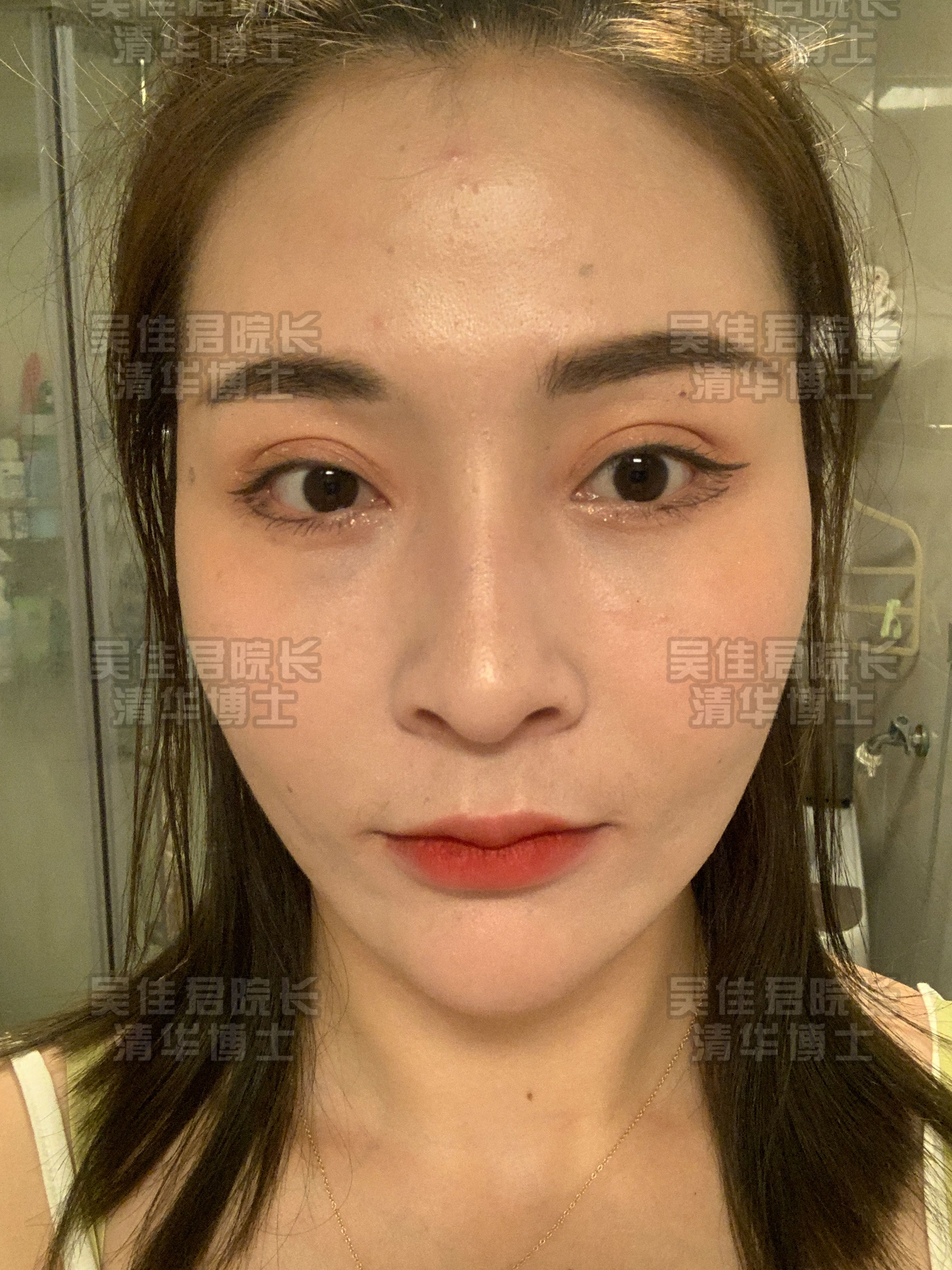 小拉皮手术后真实感受,小拉皮手术后的真实案例