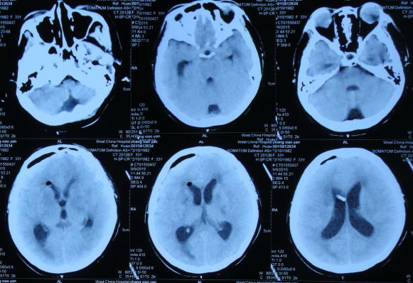 结核性脑积水,脑膜炎脑积水要治疗多久