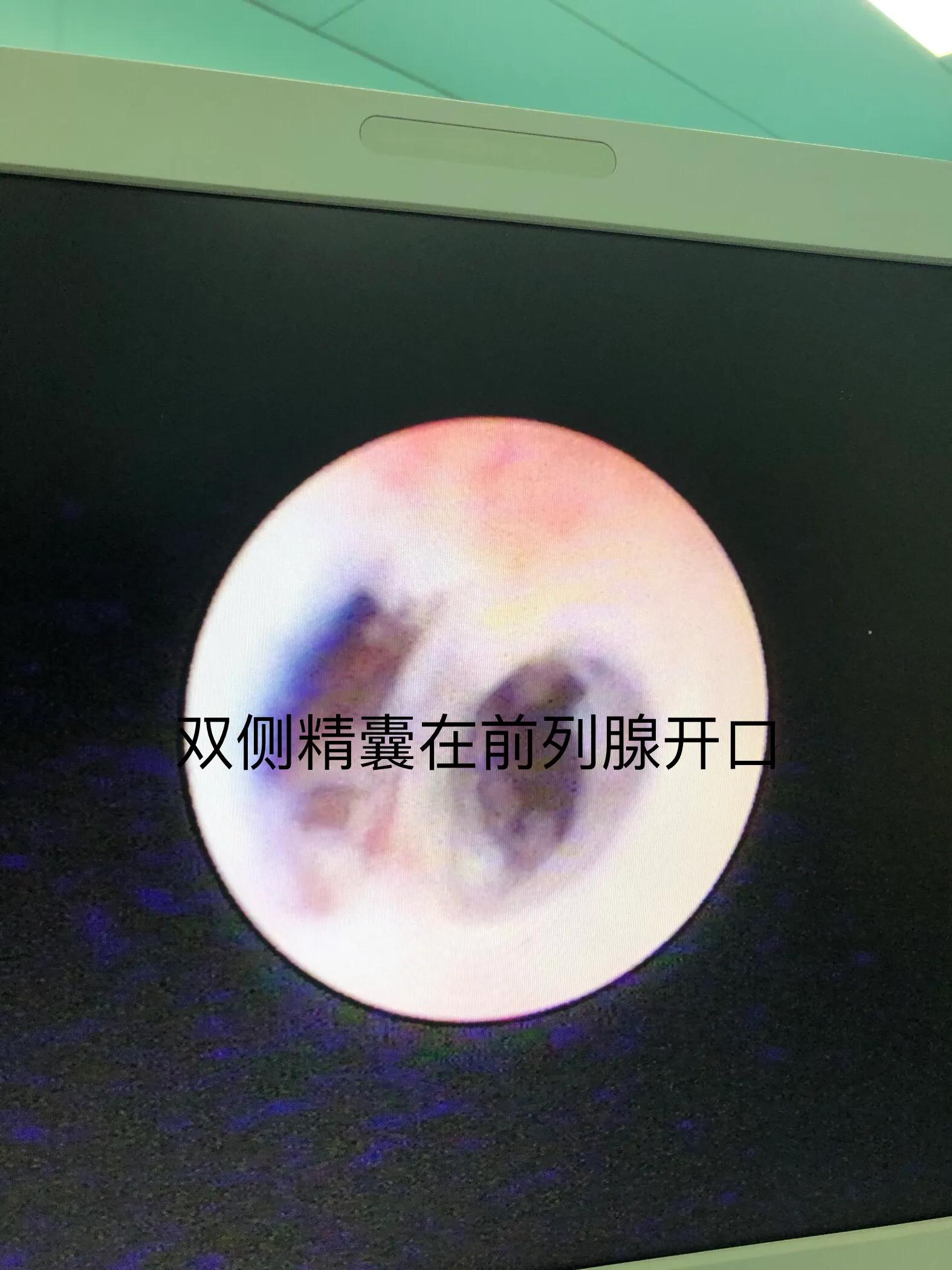 精囊结石精囊镜,精囊镜与钬激光手术