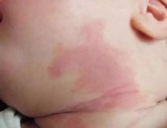 激光治疗红胎记几天能恢复,小孩身上长红胎记怎么回事