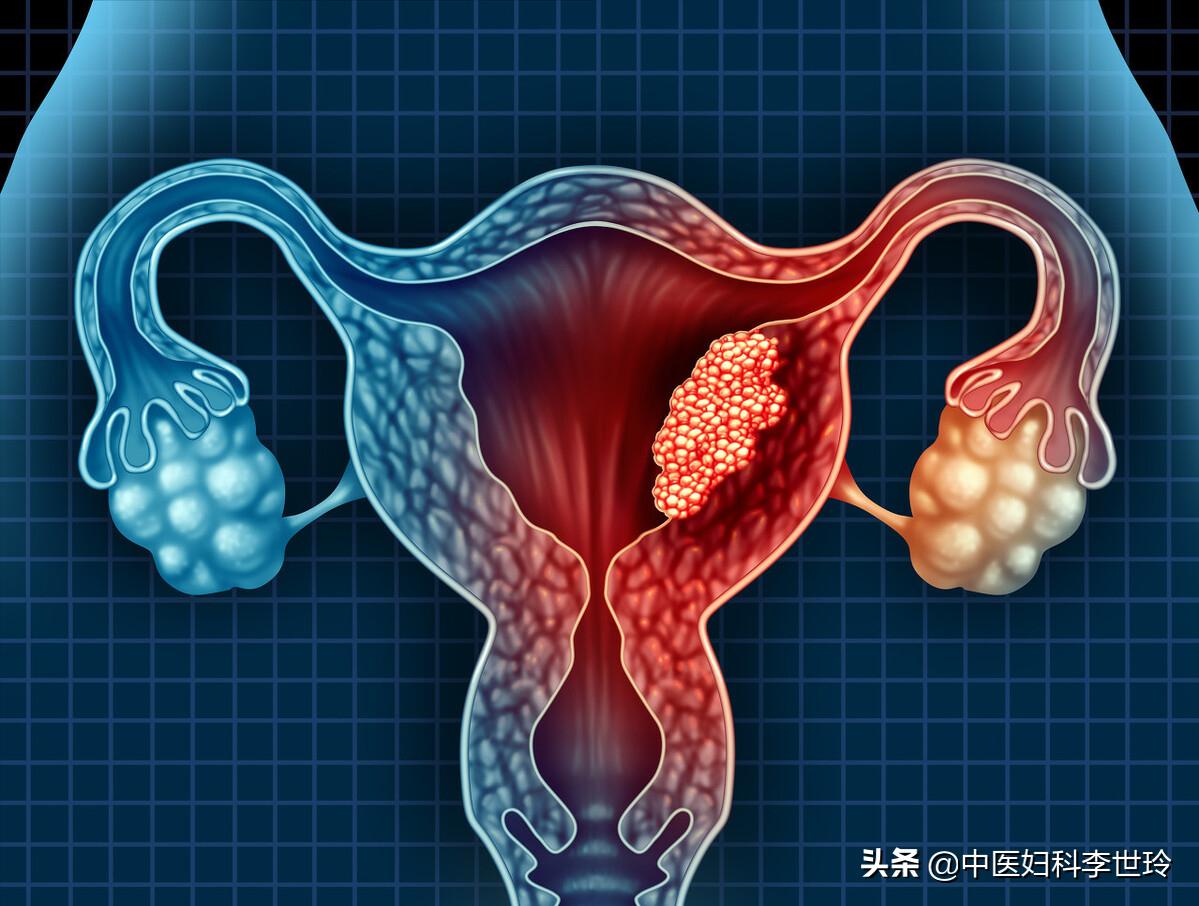 子宫腺肌症补肾补血,子宫腺肌症淤堵中药调理