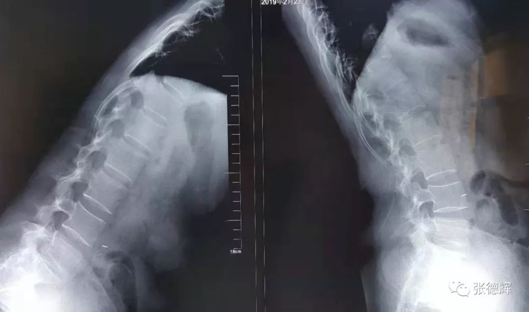 巨大腰间盘突出可以保守治疗吗,腰椎间盘突出不治疗越来越严重